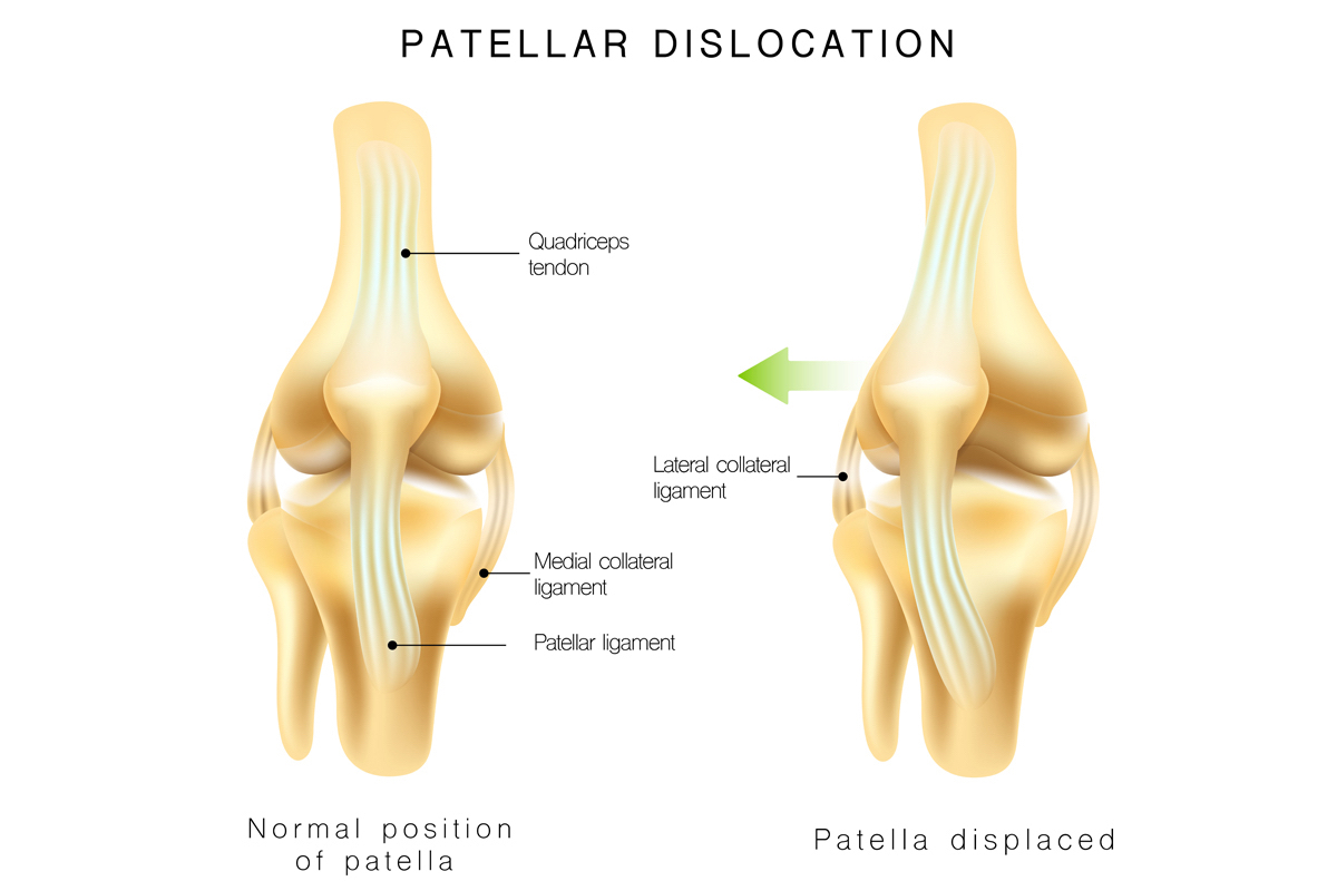 Treating Patellofemoral Dislocation
