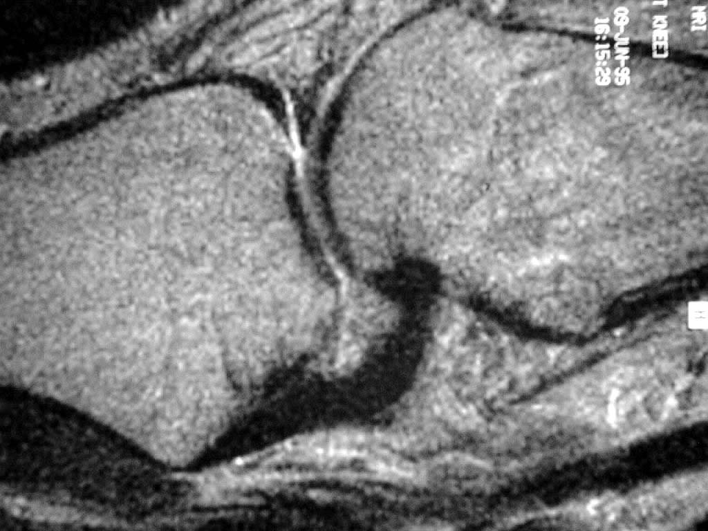 Non-Operative Treatment Works Best for PCL Tears