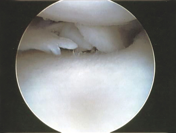 Effective Treatment for Degenerative Meniscus Tears