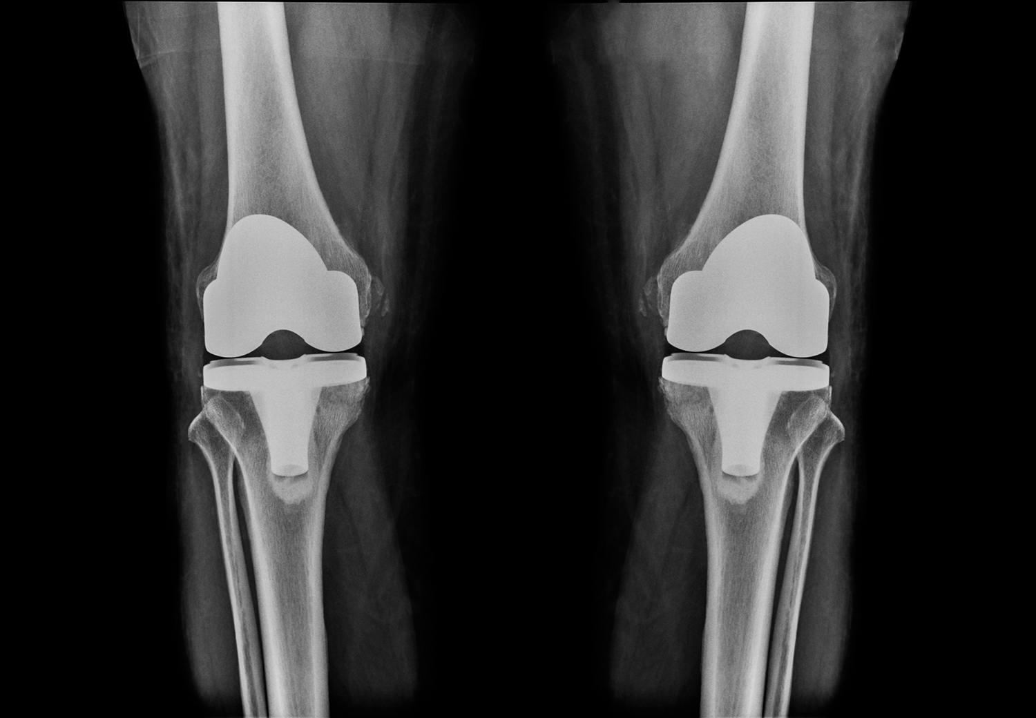 Bilateral TKA: The Right Option for Some Patients 