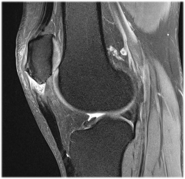 Relationship between patellar tendon length and surgical treatment for patellar tendinosis