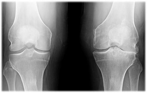 Rates of TKA Based on OA Location and Severity 