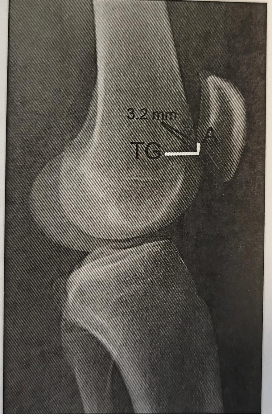 superior_edge_of_the_trochlea